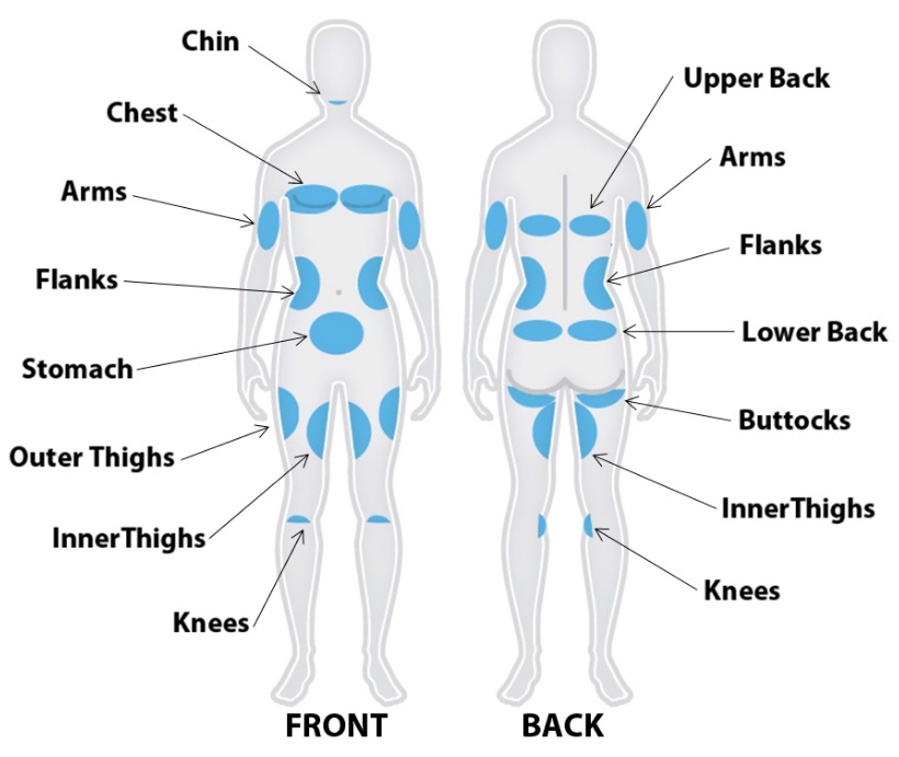 [DIAGRAM] Back Liposuction Areas Diagram