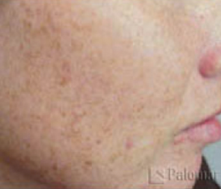 IPL - Before
