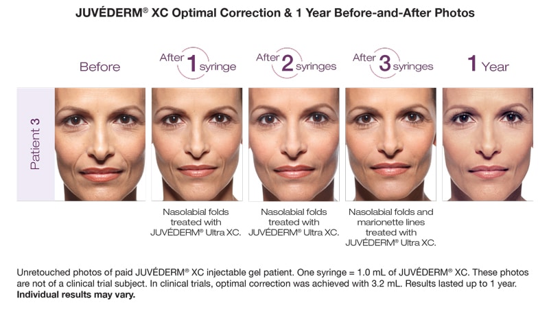 Juvederm Rockville MD