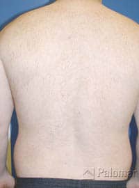After Pulsed Light Hair Removal Rockville MD