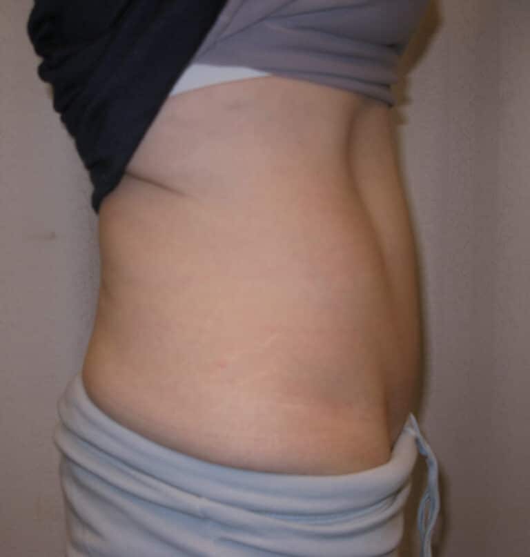 After Image: Abdominoplasty - right-side