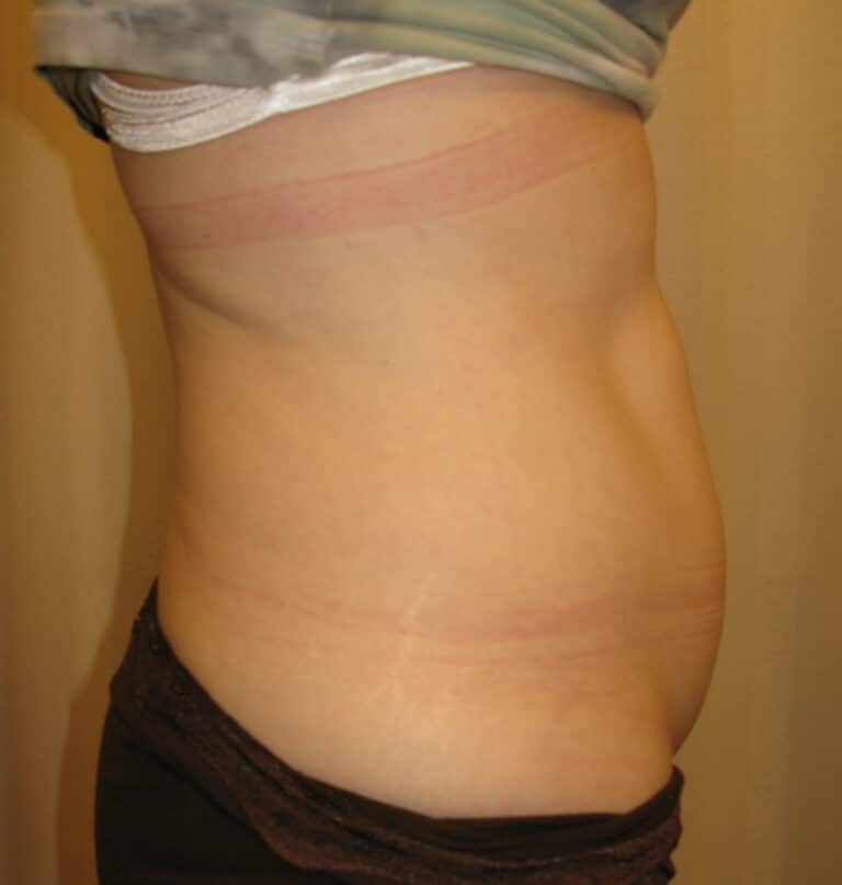 Before Image: Abdominoplasty - right-side