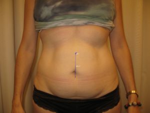 Before Image: Abdominoplasty