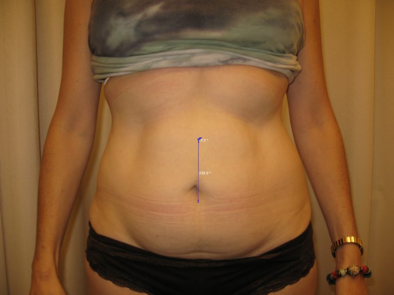 Before Image: Abdominoplasty - front