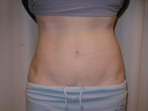 After Image: Abdominoplasty