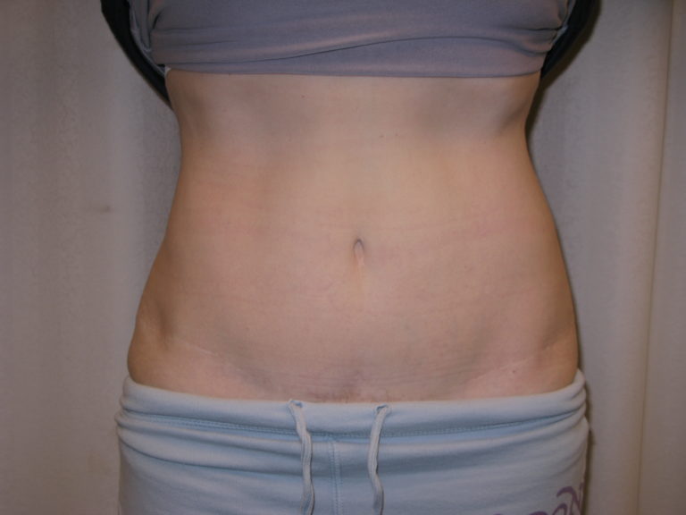After Image: Abdominoplasty - front