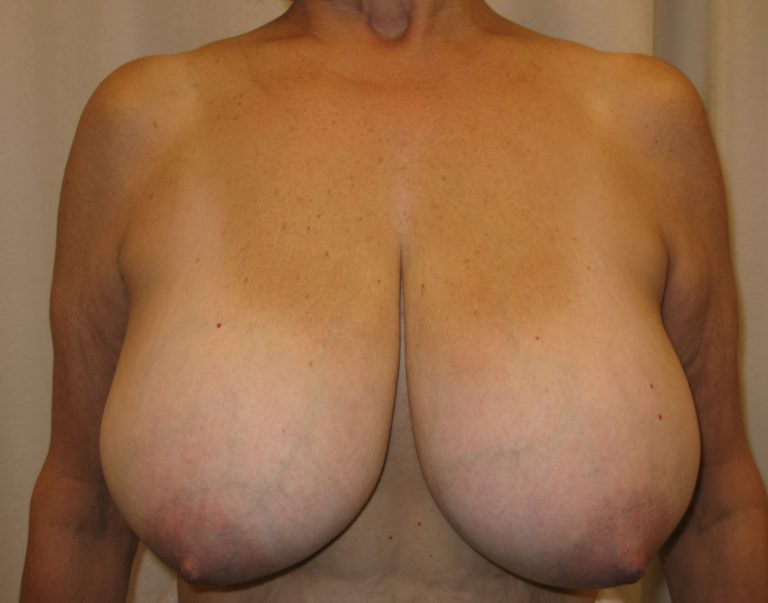 Before Image: Breast Lift and Reduction - front