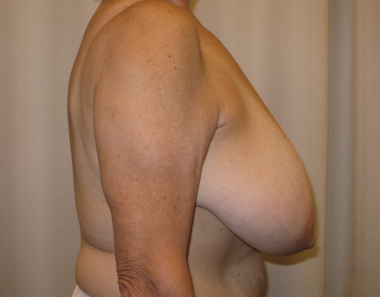Before Image: Breast Lift and Reduction -