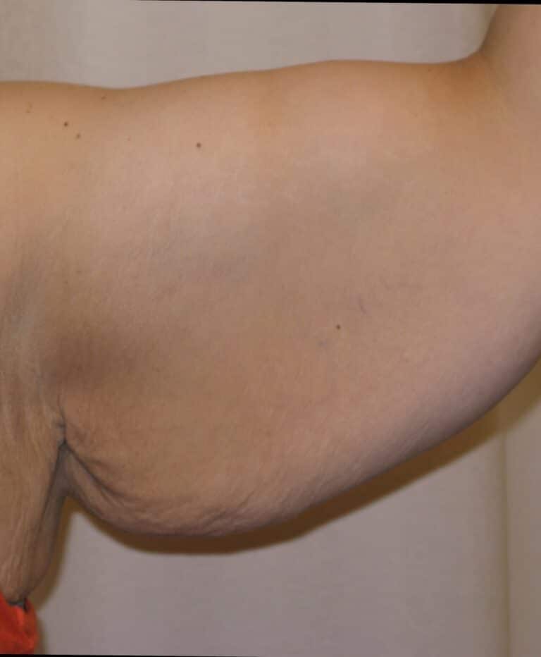 Before Image: Arm Lift - front