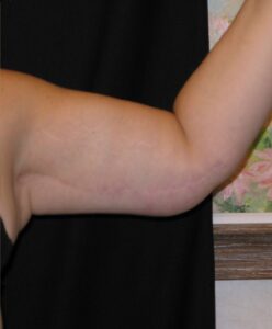 After Image: Arm Lift