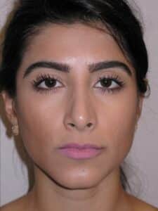 Rhinoplasty