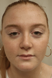 Rhinoplasty