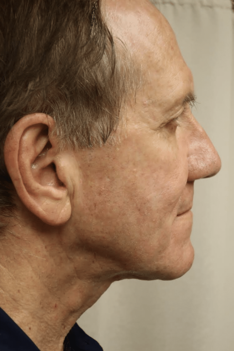 After Image: Neck Lift - right-side