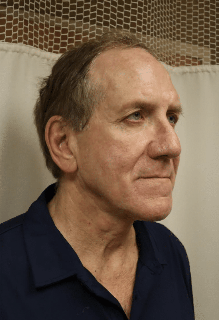 After Image: Neck Lift - front