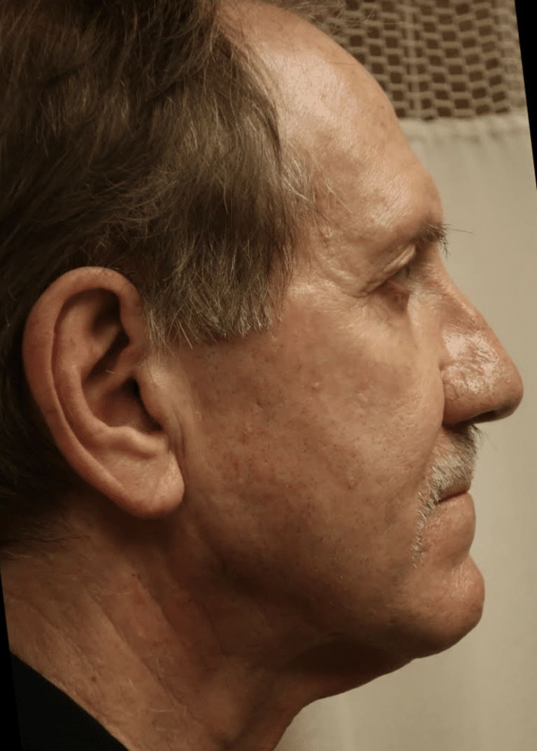 Before Image: Neck Lift - right-side