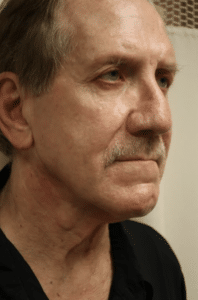 Before Image: Neck Lift