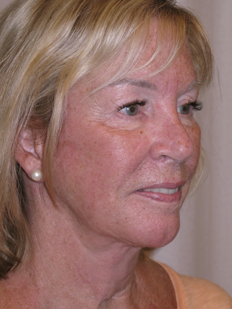 After Image: Facelift - right-front-oblique