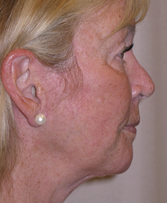 After Image: Facelift - right-side