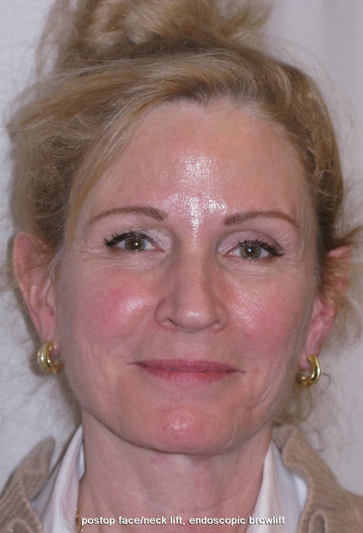 After Image: Face & Neck Lift, and Browlift - front