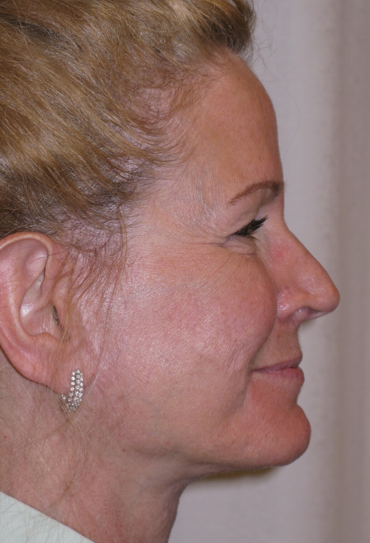 After Image: Face & Neck Lift, and Browlift - right-side