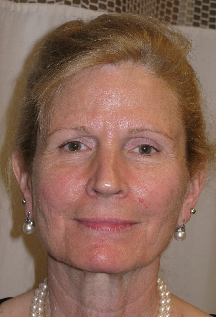 Before Image: Face & Neck Lift, and Browlift - front