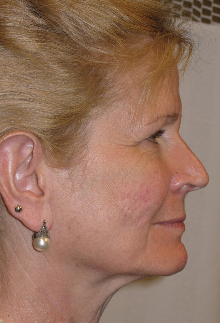 Before Image: Face & Neck Lift, and Browlift - right-side
