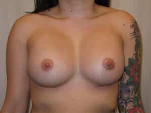 Breast Augmentation