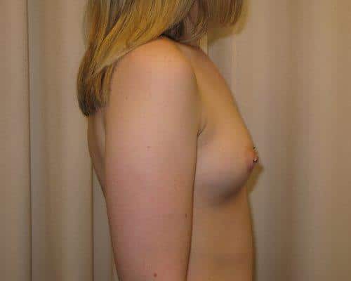 Before Image: Breast Augmentation - front