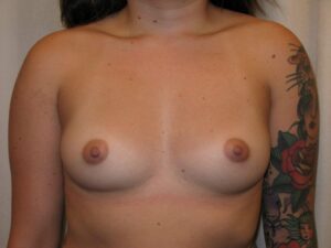 Breast Augmentation