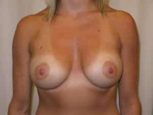 Breast Augmentation