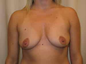 Breast Augmentation