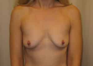 Before Image: Breast Augmentation