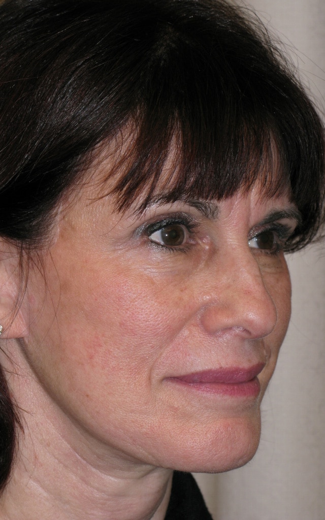 After Image: Facelift & Necklift - right-front-oblique