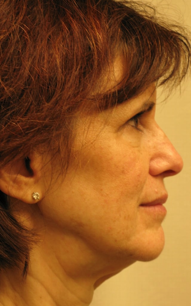 Before Image: Facelift & Necklift - right-side