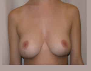 After Image: Breast Lift