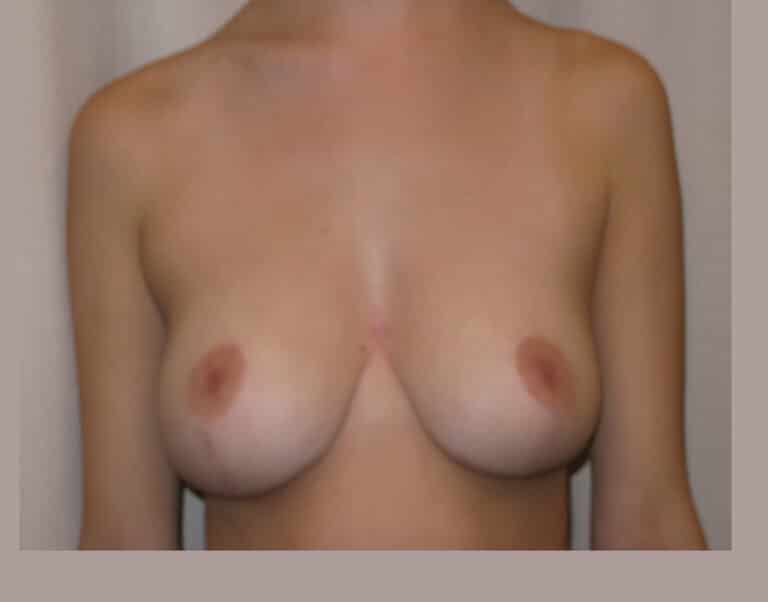 After Image: Breast Lift - front
