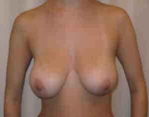 Before Image: Breast Lift