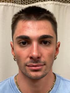 After Image: Rhinoplasty