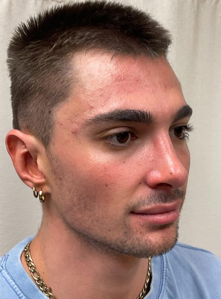 After Image: Rhinoplasty - right-front-oblique
