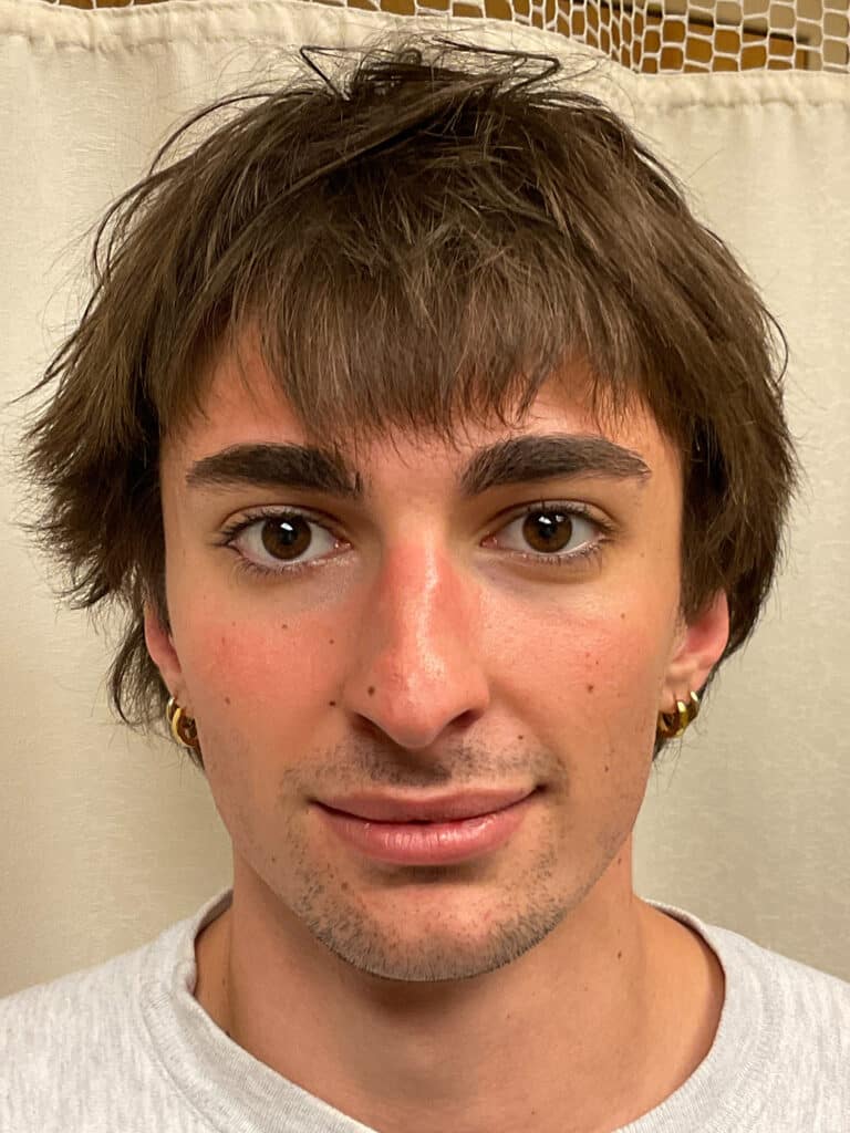 Before Image: Rhinoplasty - front