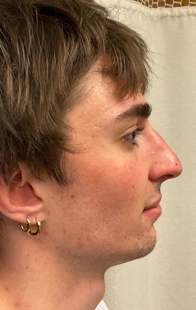 Before Image: Rhinoplasty - right-side