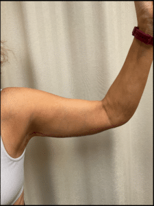 After Image: Arm Lift