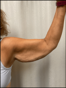 Before Image: Arm Lift