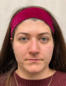 Before Image: Rhinoplasty