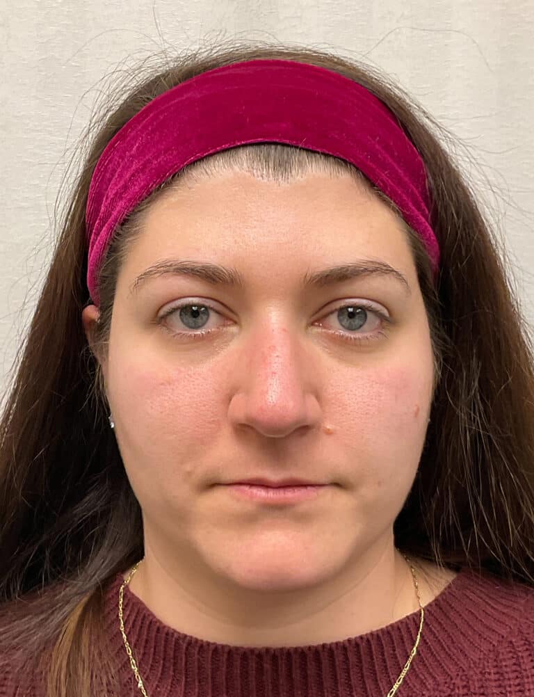 Before Image: Rhinoplasty - front