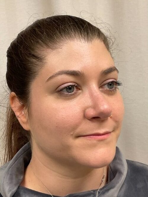After Image: Rhinoplasty - right-front-oblique
