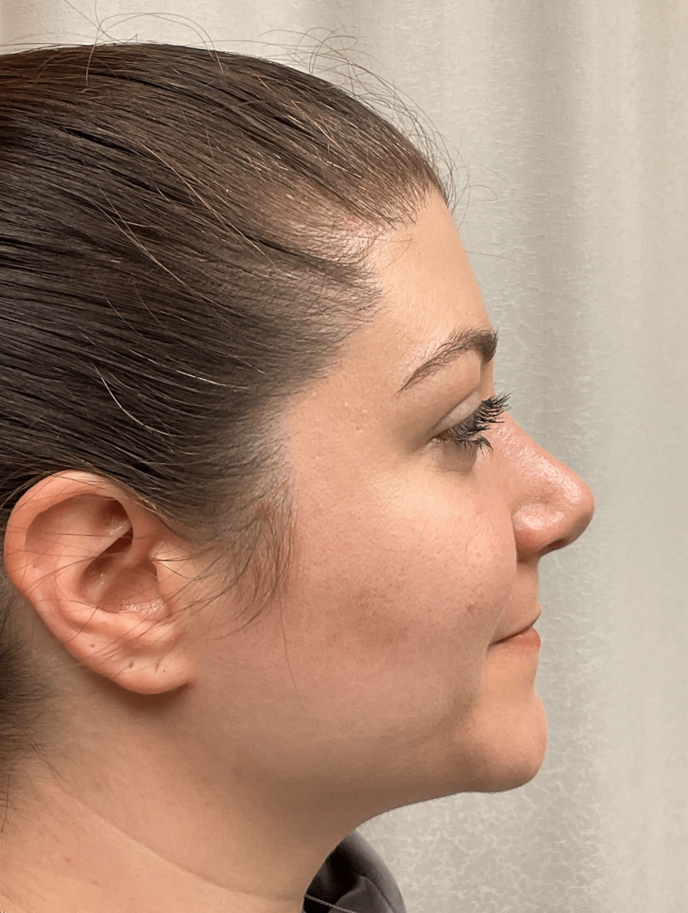 After Image: Rhinoplasty - right-side