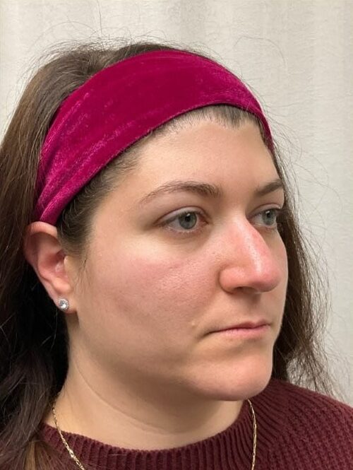 Before Image: Rhinoplasty - right-front-oblique
