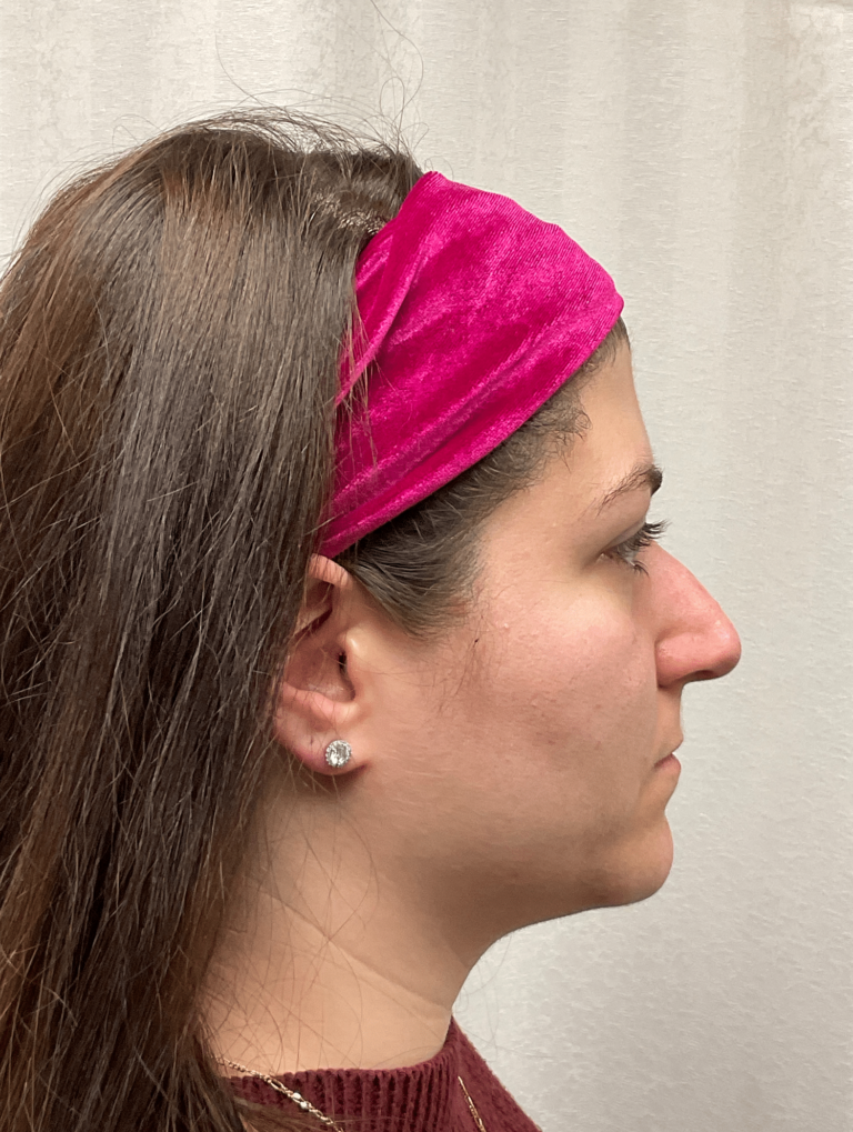 Before Image: Rhinoplasty - right-side