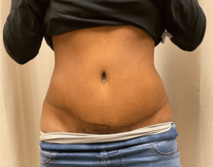 After Image: Abdominoplasty